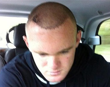 /celebrity/Rooney-Hair-Transplant